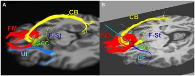 Initial Unilateral Exposure to Deep Brain Stimulation in Treatment-Resistant Depression Patients Alters Spectral Power in the Subcallosal Cingulate